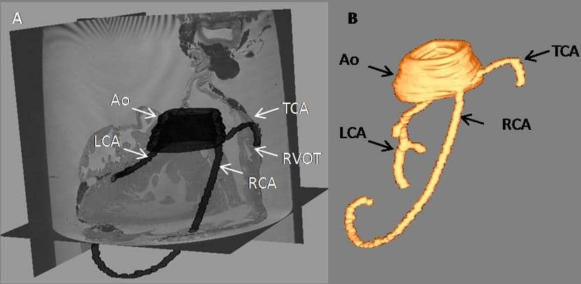 Figure 1: 3D dorso-lateral view of segmented coronary vessels in a rabbit heart. A: Segmented aortic root (Ao), left, right and third (Conus arteriosus) coronary arteries (LCA, RCA, TCA respectively). Here the segmented vessels are superimposed with 2D MRI image stacks of the cardiac tissue, using Seg3D software for visualisation. The TCA originates ventrally of the RCA, proceeding towards the right ventricular outflow tract (RVOT). B: Segmented vessels generated using Taratula and Meshalyzer for visualisation.