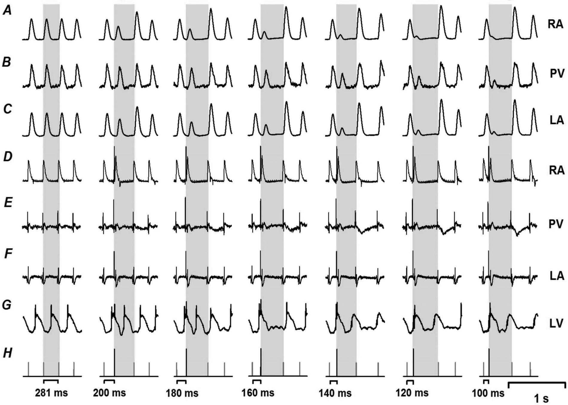 Figure 1. Functional refractory period of atrium and pulmonary vein regionA, B and C, recordings of contraction force of right atrium (RA), pulmonary vein region (PV) and left atrium (LA). D and G, traces of MAP action potential of RA and LV. E and F, bipolar electrograms of PV and LA. H, gray lines indicate the time of right atrium action potential (RAAP) depolarization; black lines with higher amplitude show electrical stimulation at RA.