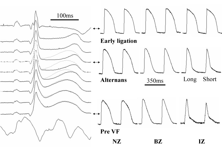 Progressive changes in ECG (left) and optical action potentials (right) following coronary artery ligation. The top trace was recorded 1min following coronary artery occlusion; the traces below represent the final 8 mins prior to VF at 14 mins. Successive ECG traces are shown in black and grey showing a 3-4min period of marked alternans. Recordings from sites in normal ‘border’ and ‘infarct’ zones (NZ BZ & IZ) are shown next to corresponding ECGs.