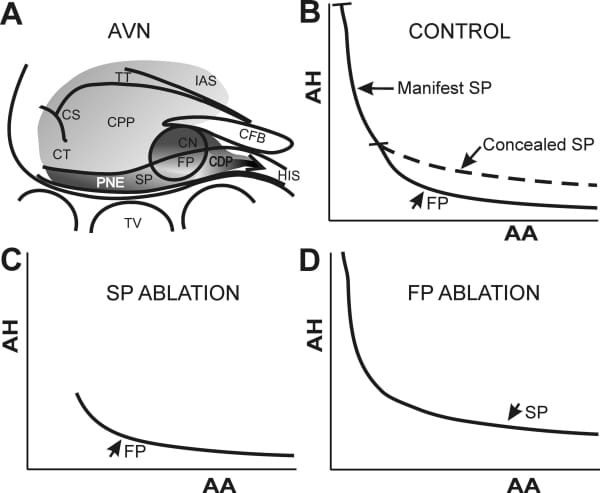 Figure 1: Schematic representation of dual AV nodal pathways. A, AV node structures and landmarks. B, dual pathway conduction curve (normal AV node). C, FP conduction curve after posterior extension ablation. D, SP conduction curve after FP ablation. FP, fast pathway. SP, slow pathway. CPP, common proximal pathway. CDP, common distal pathway. AH, atrial-His interval. AA, atrial cycle length.