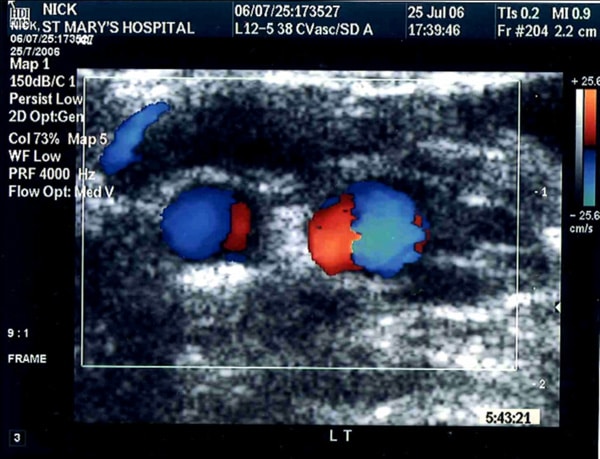 Swirling flow pattern in the left (LT) carotid arteries of a 23 yr. old healthy male volunteer. ECG-gated scan in the right common femoral artery (CFA) during systolic flow showing Dean vortices.