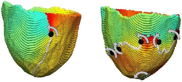 Figure 1. A single epicardial re-entrant wave (left) and multiple epicardial wavefronts (right) in the same patient. The spectrum shows electrophysiological phase and filled circles show phase singularities (with chirality indicated by the arrows) at the ends of the wavefronts (grey lines).