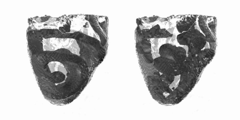 Figure 1. Re-entry and VF in the DT-MRI virtual ventricles. Snapshots of dark-grey voltage isosurfaces are shown within the pale-grey ventricles at 2 s. The slow inward Ca2+ current is either normal (right) or decreased by 50% (left) whereas the tissue anisotropy is the same in both cases.