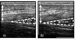 Figure 1. Typical sonographs of the sagittal plane of the vastus lateralis muscle at rest with the knee at an angle of 85Deg (right angle is 90Deg). A) AM and B) PM showing pennation angle (theta) and muscle thickness (t).