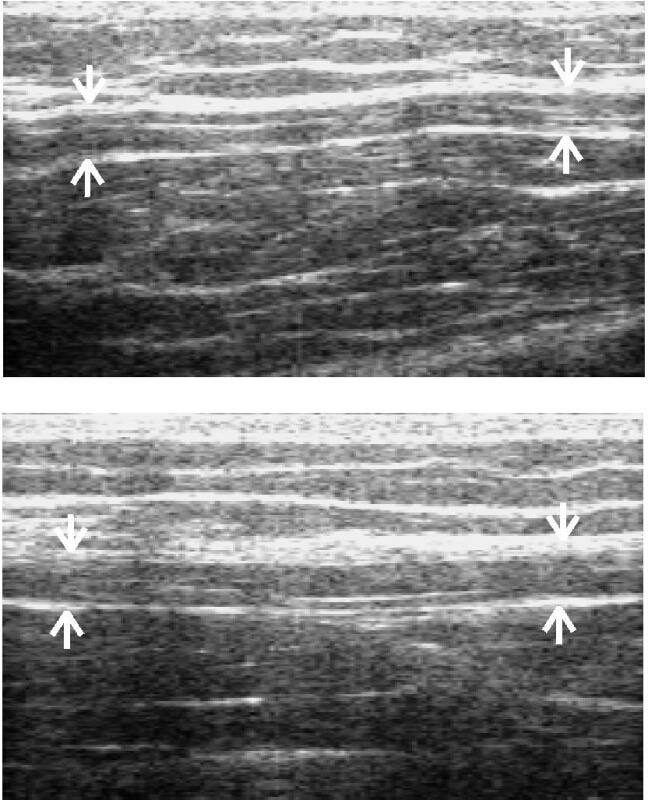 Figure 1. (upper) Nerve trunk bowing with arm by side and (lower) straightening with combined elbow flexion shoulder abduction and wrist extension a position designed to tension the ulnar nerve.