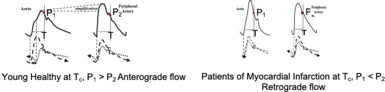 Figure 2. Proposed mechanism for alteration in waveforms leading to oscillatory flow in Myocardial Infarction