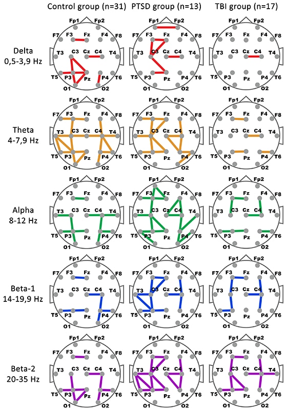 Figure 1. Functional connectivity in control (n=31), PTSD (n=13) and mTBI (n=17) groups estimated as EEG coherence between respective pairs of electrodes in delta (0,5-3,9 Hz), theta (4-7,9 Hz), alpha (8-12 Hz), beta-1 (14-19,9 Hz) and beta-2 (20-35 Hz) bands.
