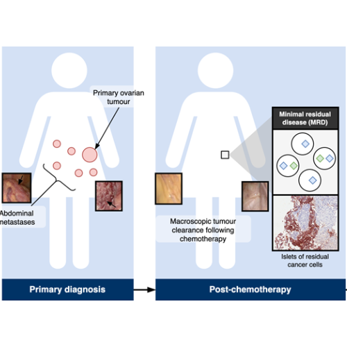 Using AI to develop better ovarian cancer treatment - The Physiological ...